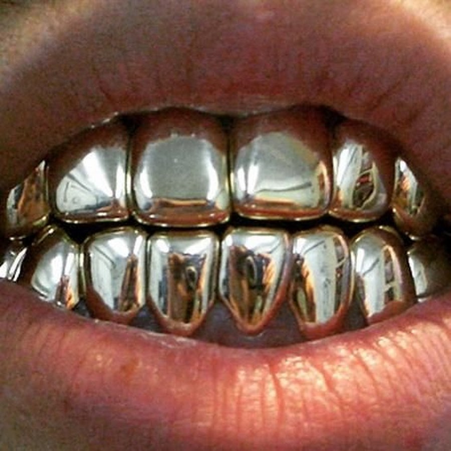 Сколько стоит металлические зубы. Металлическая коронка. Вставные металлические зубы.