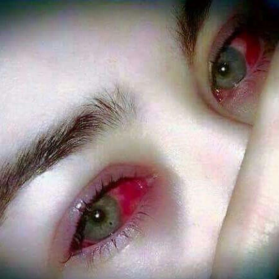 Красные глаза от слез фото