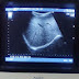 Ultrasound Atifa mohammadi