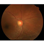 Retina and cataract Musha M