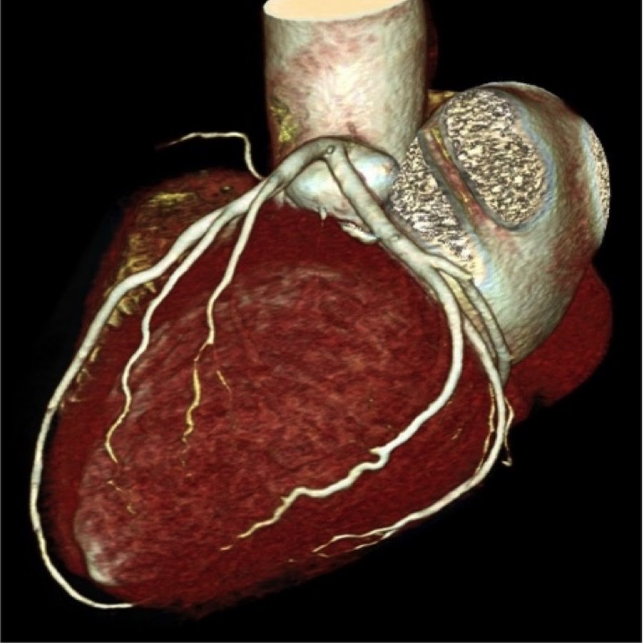 Фото сосудов сердца. Кт коронарография сосудов. Кт коронарография сосудов сердца. Кт коронароангиография сосудов сердца. Кт-ангиография коронарных артерий.