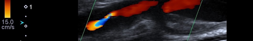 US Doppler Vascular