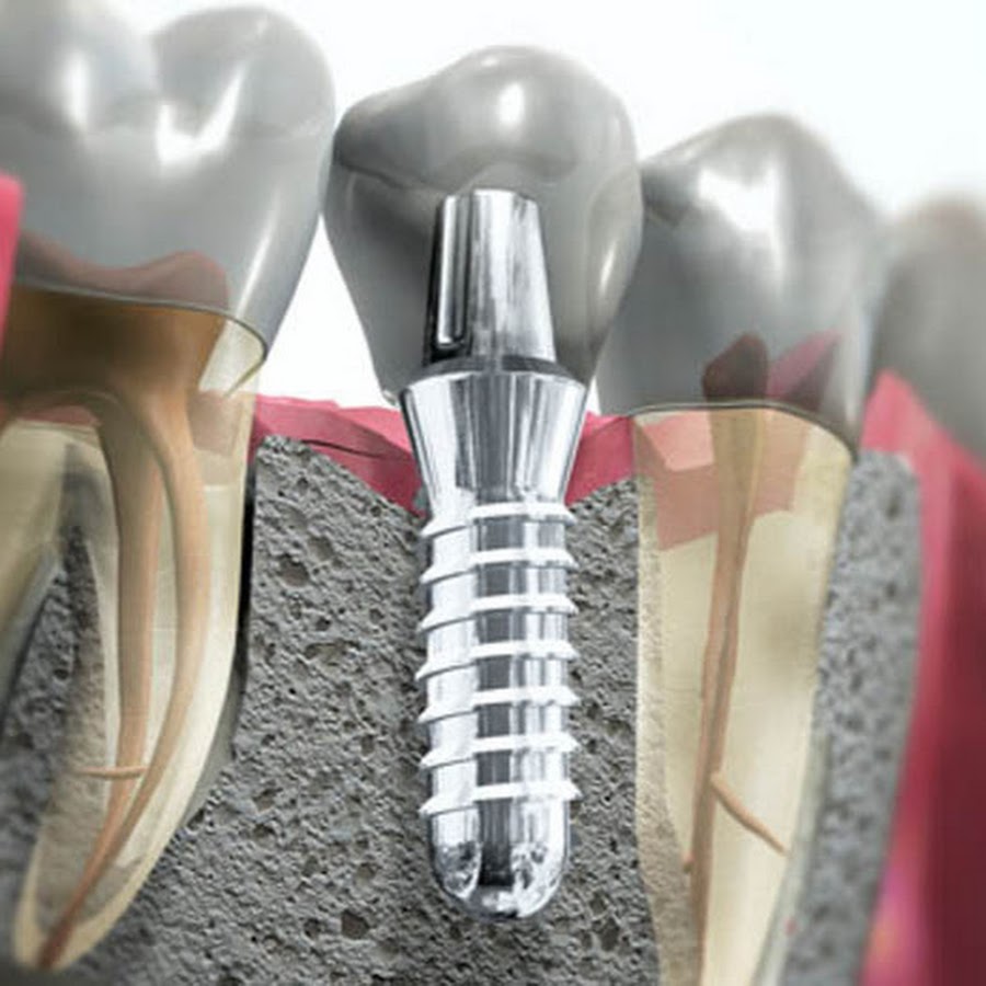 Имплантат формирователь коронка