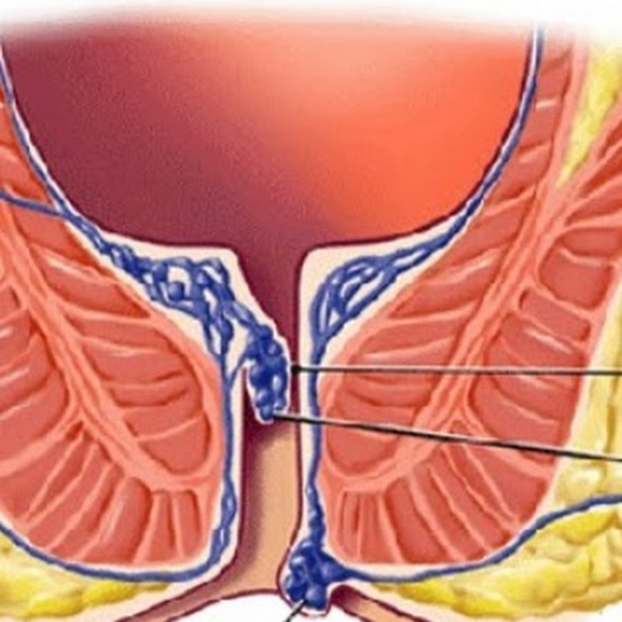 Как выглядит внутренний. Цвет геморроидальных узлов.