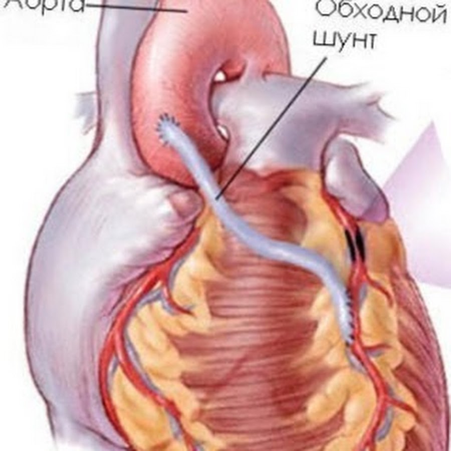 После сердца. Инфаркт миокарда шунтирование. Инфаркт операция шунтирование. Инфаркт миокарда рубец. Шунтирование после инфаркта миокарда.