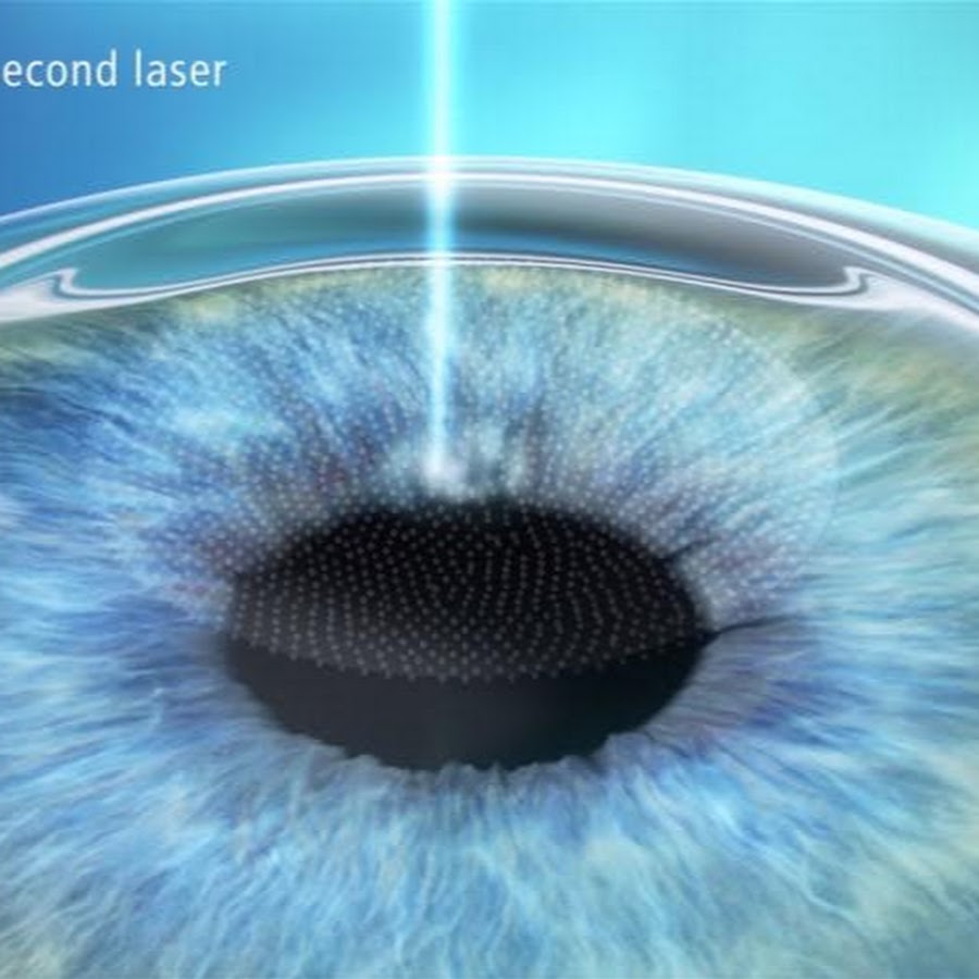 Relex smile. LASIK лазерный кератомилез. Ласик Фемто ласик ФРК.