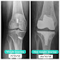 Knee Replacement Rehab Resource