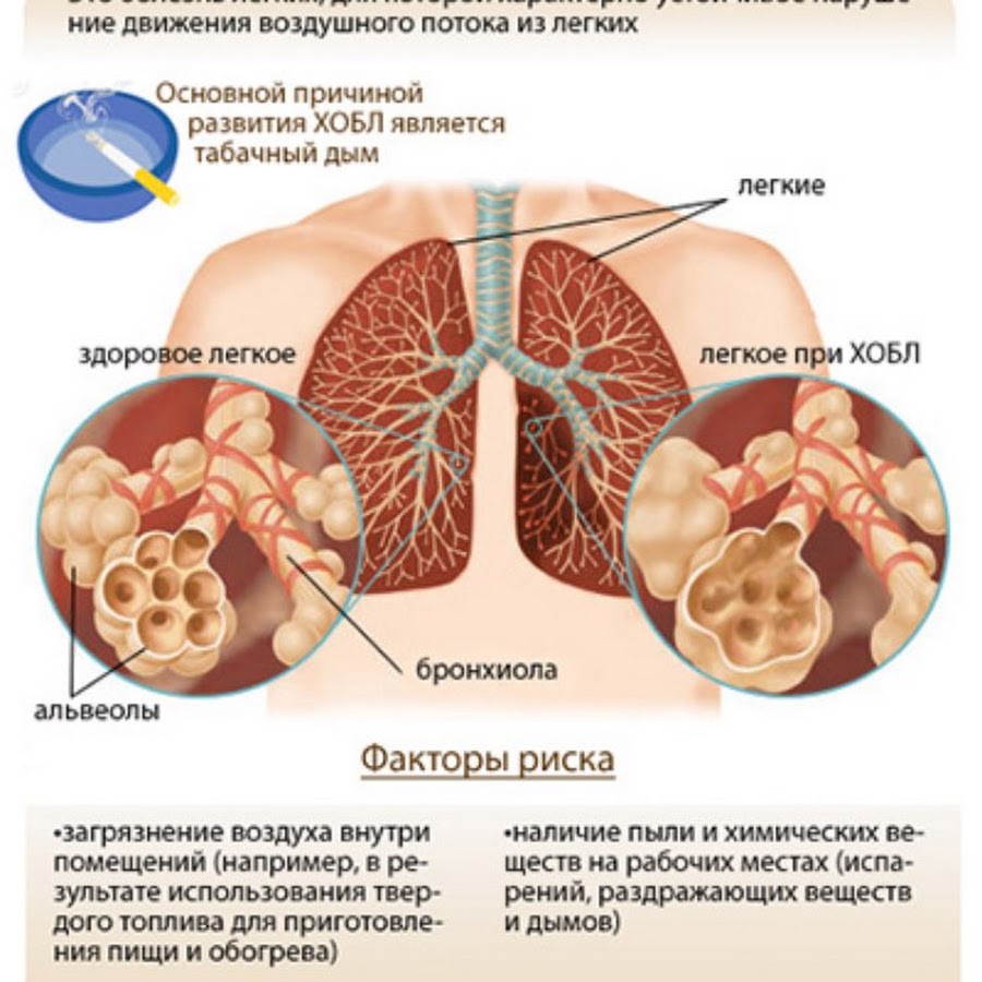 Evali болезнь легких. Причина хронической обструктивной болезни лёгких (ХОБЛ. Хроническая болезнь легких ХОБЛ симптомы. Хроническая обструктивная болезнь лёгких симптомы симптомы.