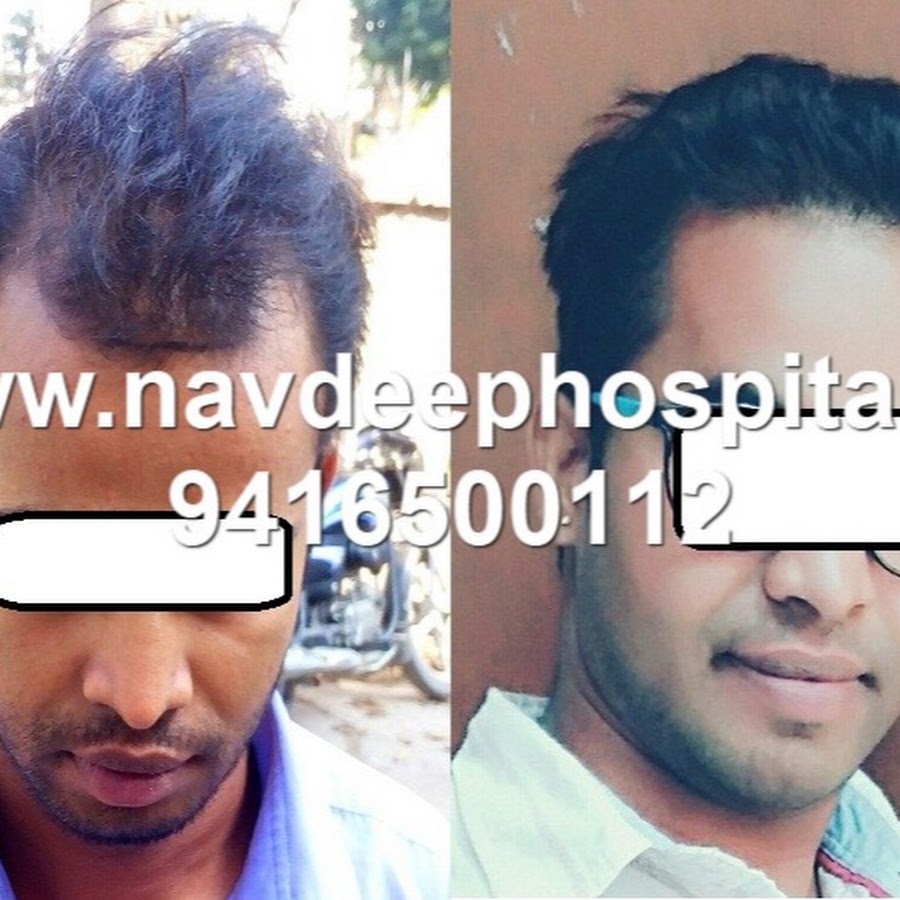 Navdeep Hair Transplant & Laser Clinic - Best FUE Hair Loss Transplant  Treatment Doctors in Panipat - YouTube