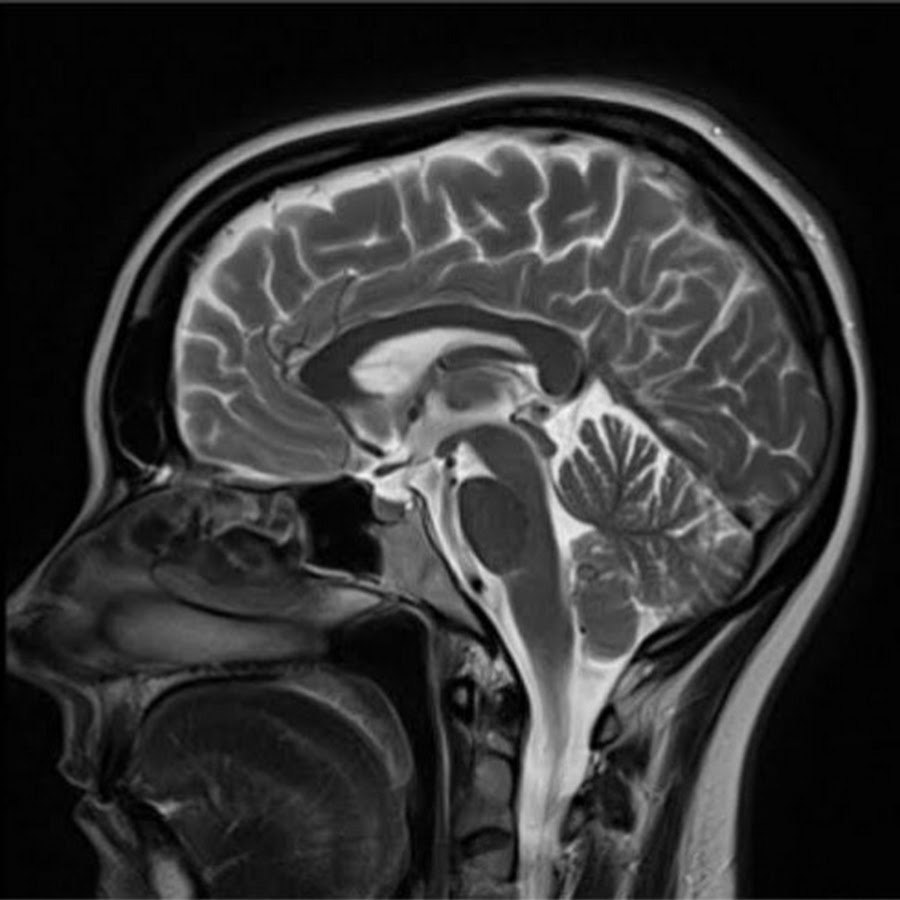 Снимки мрт головного мозга. MRI головного мозга. T2 MRI. T2 мрт головной мозг. Томограмма ГМ.