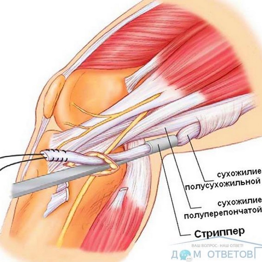 Лечение сухожилий. Сухожилие подколенной мышцы анатомия. Тендинит полуперепончатой мышцы. Теносиновит полусухожильной мышцы. Теносиновит сухожилия полуперепончатой мышцы коленного сустава.