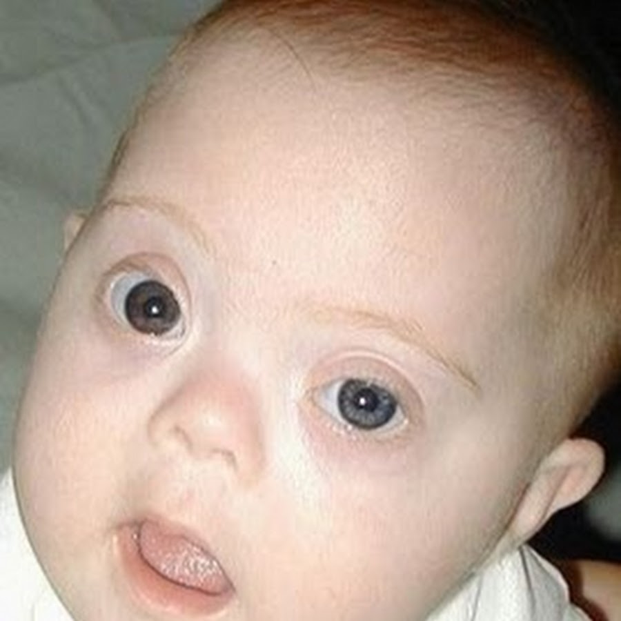фото новорожденного ребенка с синдромом