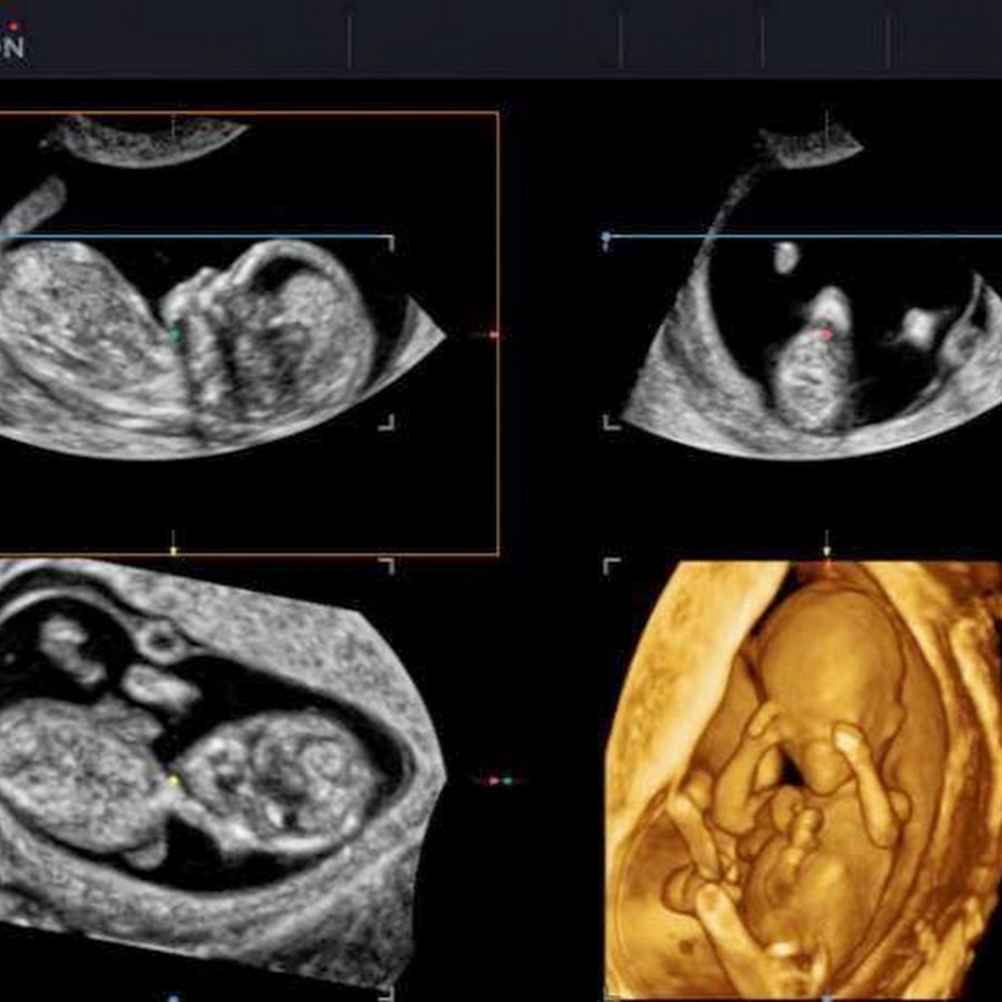 Третий скрининг. 3д УЗИ на 13 неделе беременности. 4 Д УЗИ на 13 неделе беременности.