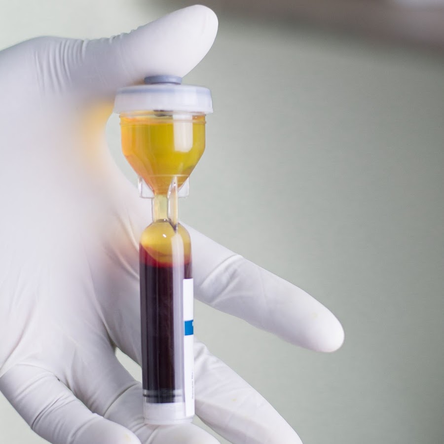 PRP-терапия (Platelet Rich Plasma). РRP - терапия плазмотерапия. Плазмотерапия пробирка PRP. PRP-терапию (плазма обогащенная тромбоцитами).