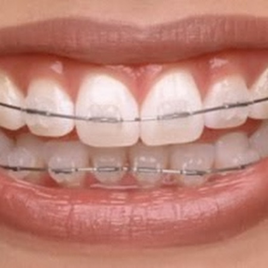 Брекеты на зубы для детей сколько стоят. Приспособление для выпрямления зубов. Скобы для выпрямления зубов. Пластина для выпрямления зубов.