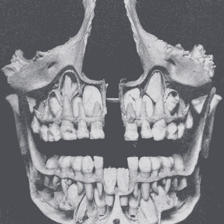 Детский череп фото. Молочные и коренные зубы рентген.