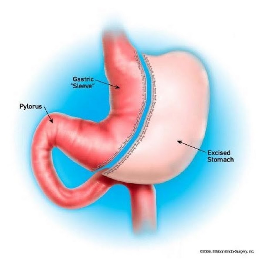 Что такое резекция желудка для похудения. Лапароскопическая продольная «рукавная» резекция желудка. Продольная резекция желудка _Sleeve Gastrectomy. Рукавная гастропластика желудка.