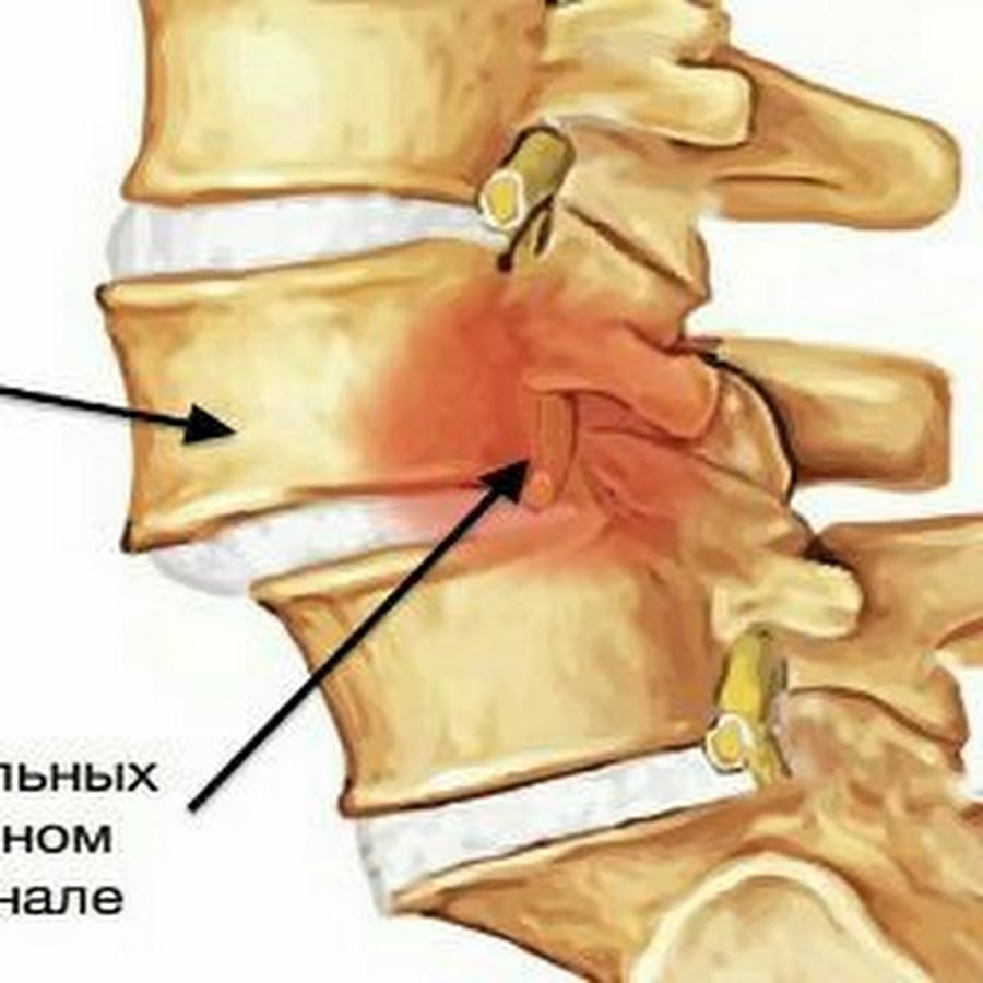 Артроз шейного позвоночника. Спондилез крестцового отдела. Антелистез l5 позвонка бандаж. Деформирующий спондилоартроз пояснично-крестцового. Деформирующий спондилёз пояснично-крестцового что это.